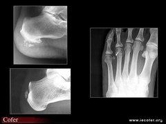 calcifications d'hydroxyapatite aux pieds